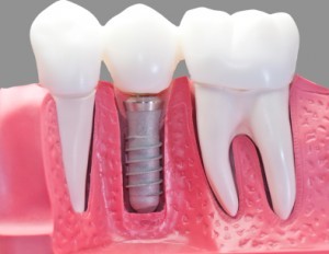 implante-dental-imagen